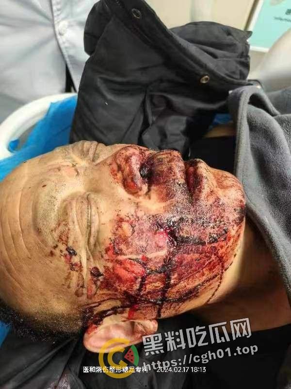 北京马坊镇放火杀人案 犯人【刘峰强】被抓 受害人全身烧烂 手臂被砍 全家老小失去人形 惨不忍睹 血腥慎点-16