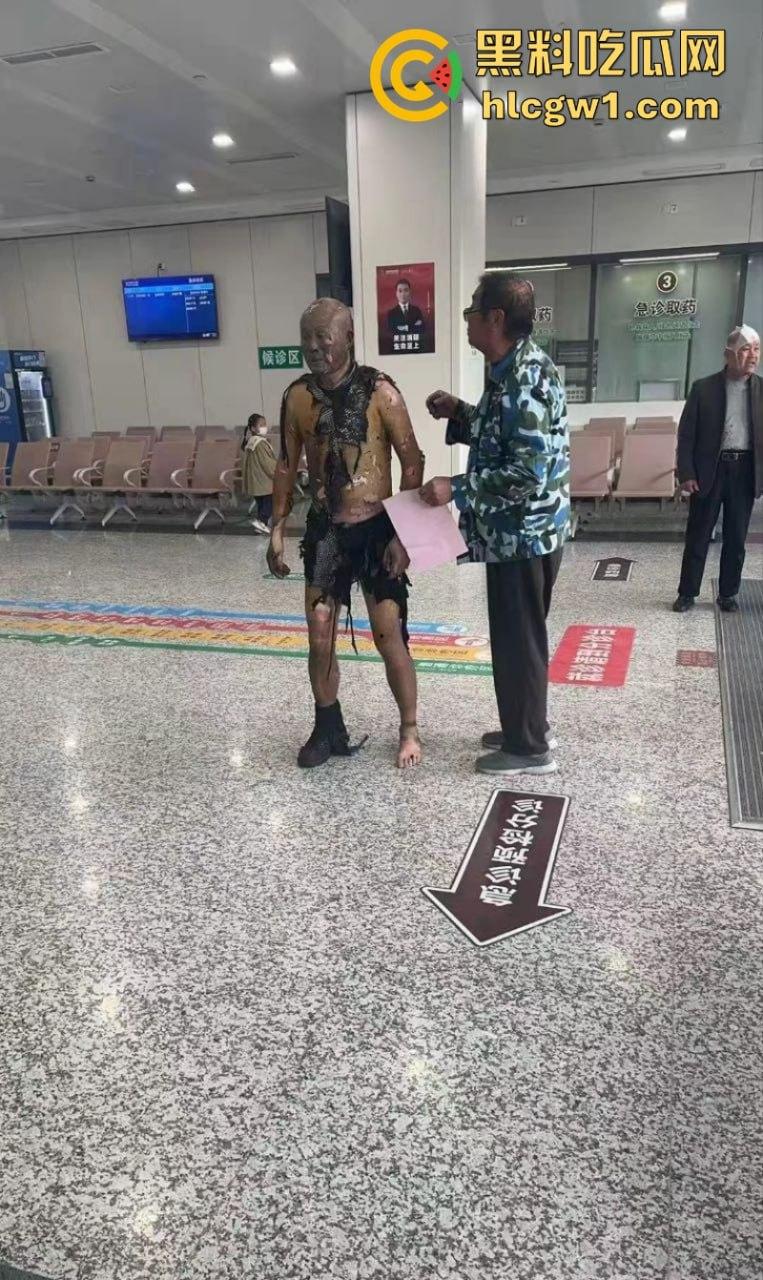 江苏常州易化工厂油罐爆炸 现场员工大面积烧伤 场面骇人 现场视频曝光皮都烧掉了-5