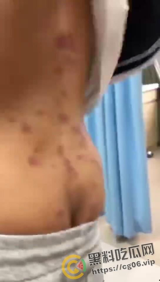 初三学生化身毒王 梅毒三期 艾滋 浑身腐烂 牛子流脓 还说自己没有过性生活 检查现场视频曝光-2