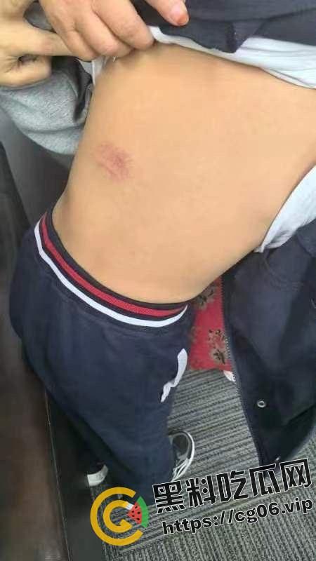 泰州外国语小学老师暴打小学生 全身淤青 家长群内声讨被解散 至今无说法-18